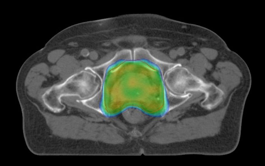 Homogene Dosis in der Prostataregion mit guter Schonung der Risikoorgane Rektum und Hüftköpfe