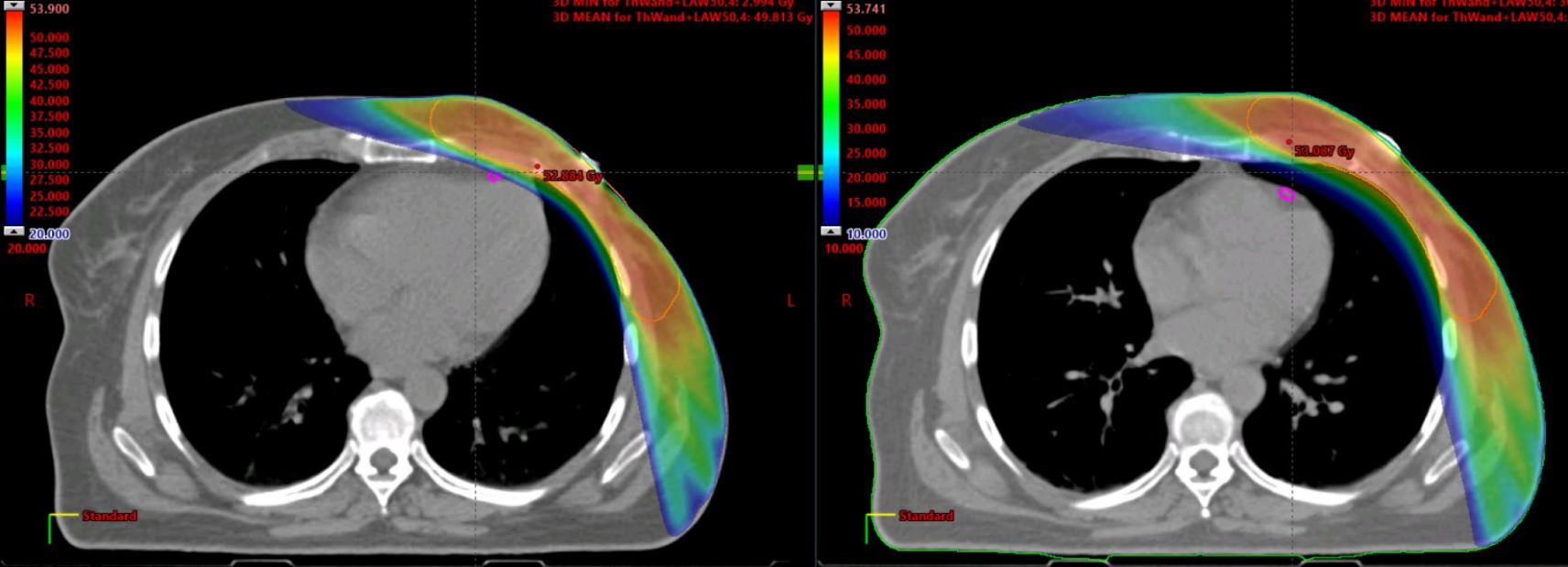 Dosisverteilung bei linksseitiger Mamma-Bestrahlung in Normallage (links) und in tiefer Inspiration (DIBH) (rechts). Schonung des vorderen Herzkranzgefäßes (Markierung) in DIBH-Technik.