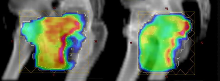 Variation der Strahlendosis innerhalb des Strahlenfeldes, Kombination vieler derartiger Felder ergibt eine homogene Dosisverteilung
