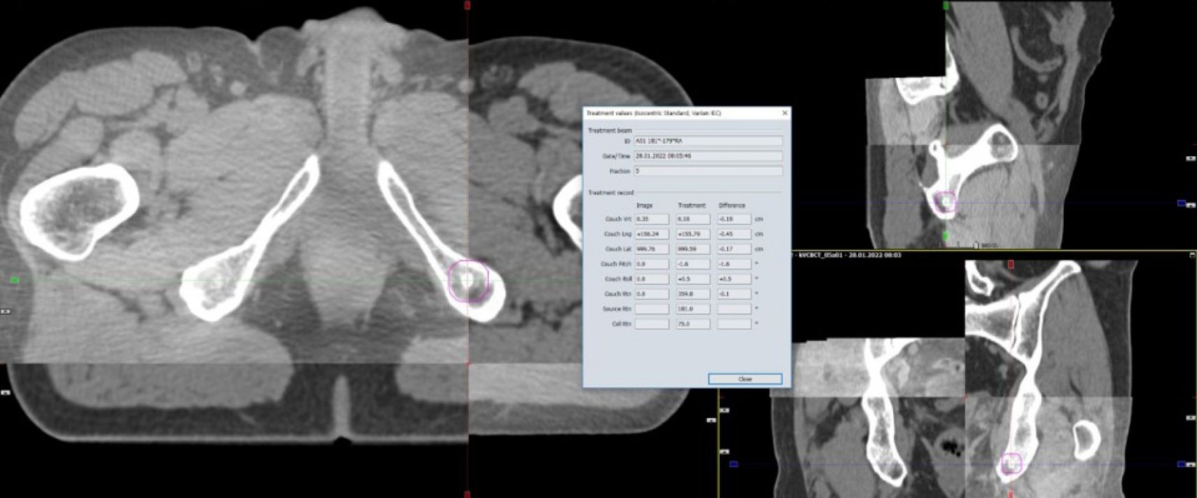 Die Überlagerung von Cone Beam CT (CBCT) mit Planungs-CT in Bruchteilen in Bruchteilen von Sekunden ermöglicht eine mm-genaue Lagerungskorrektur vom Bedienpult aus.