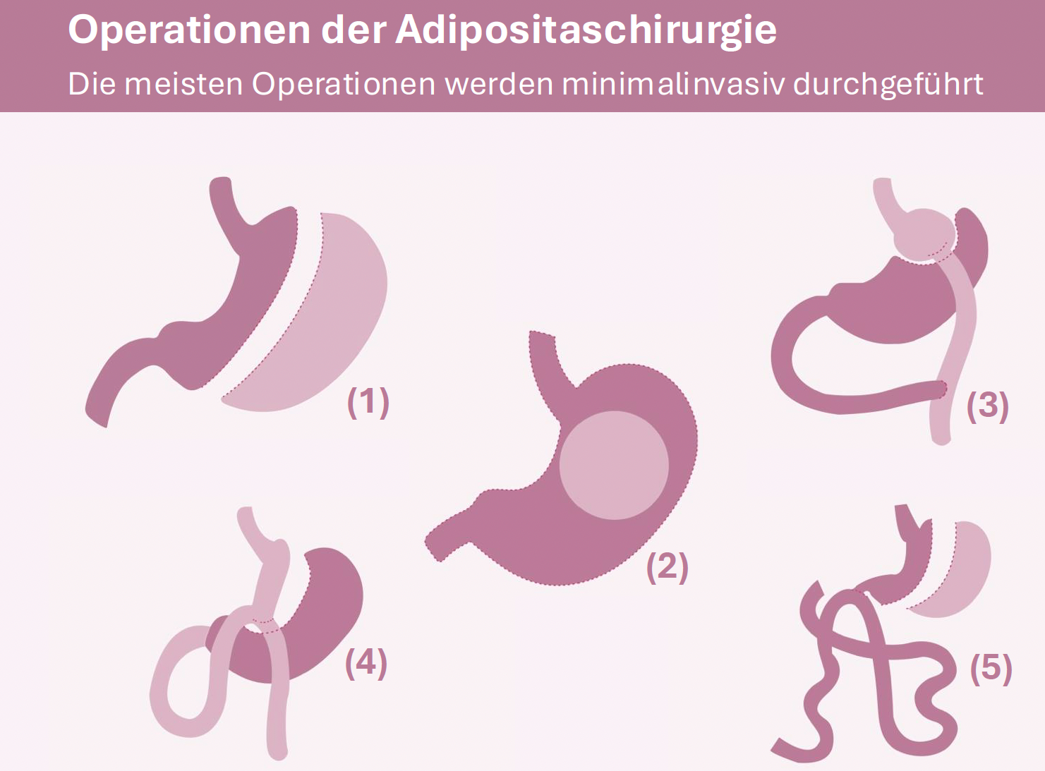 Abbildung: (1) Magenschlauch (Sleeve), (2) Magen-Ballon, (3) Magenbypass, (4) Omega- Bypass, (5) SADI